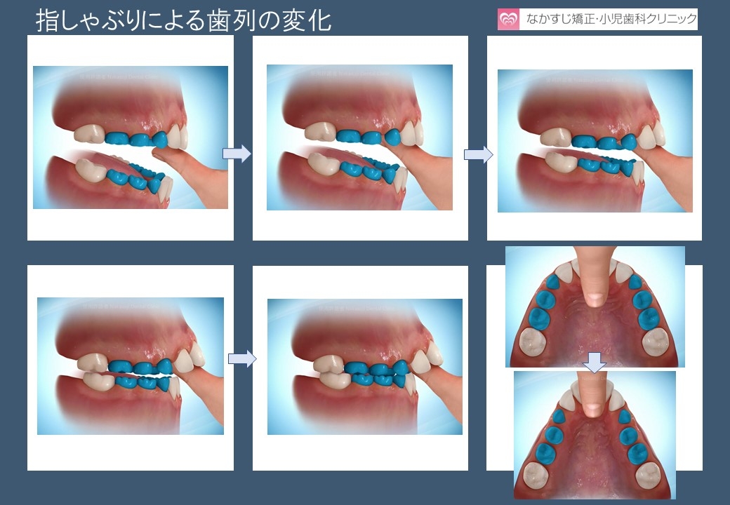 指しゃぶり 歯列の変化 大阪豊中市の歯科矯正治療 なかすじ矯正 小児歯科クリニック