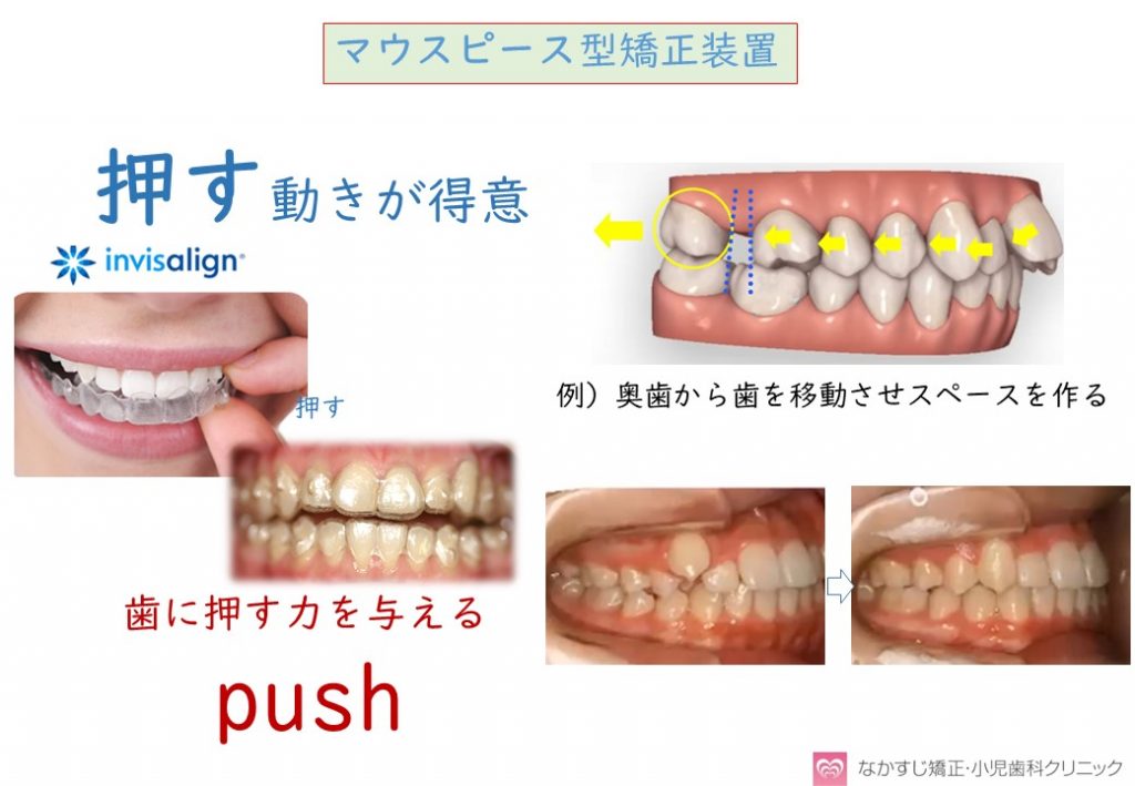 矯正治療（ブラケット・ワイヤー装置とマウスピース装置）の違い | 大阪豊中市の歯科矯正治療 なかすじ矯正・小児歯科クリニック