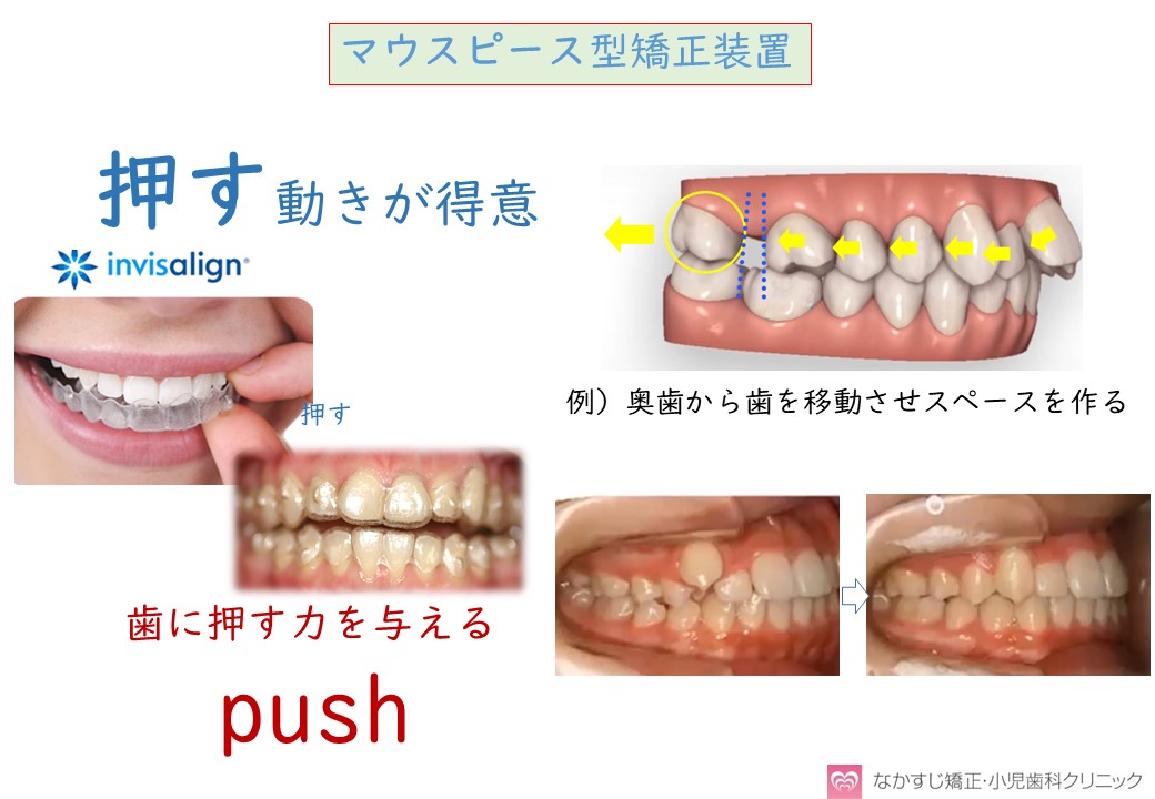 矯正治療 ブラケット ワイヤー装置とマウスピース装置 の違い 大阪豊中市の歯科矯正治療 なかすじ矯正 小児歯科クリニック
